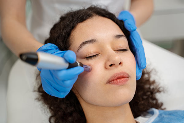 Microneedling Treatment