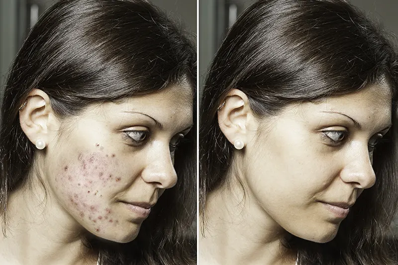 Best Treatment for Pimples